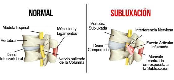 Vértebras en posición normal vs vértebras con subluxación